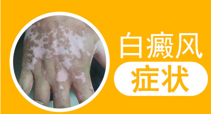 工具推荐类:如何选择最佳的白癜风专科医院—国丹医院