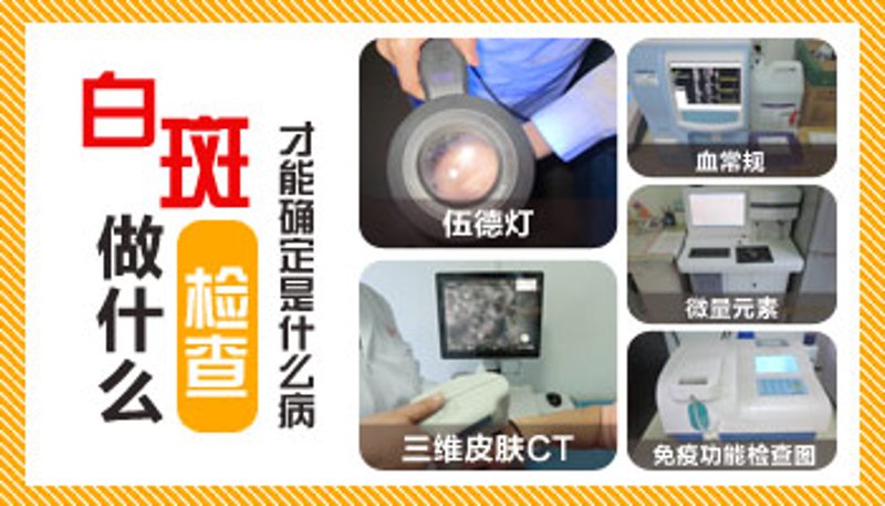 成都治疗白癜风